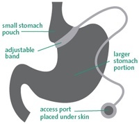 Adjustable Gastric Band