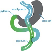 Roux-en-Y Gastric Bypass
