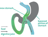 The single anastomosis gastric bypass 