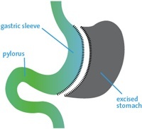 Sleeve Gastrectomy